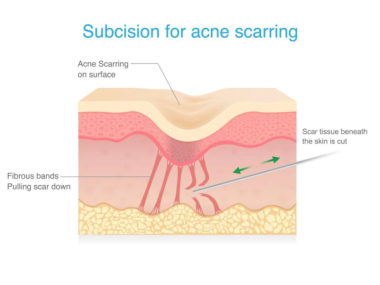 Subcision là gì? Vì sao nhiều trường hợp sẹo rolling phải cắt đáy sẹo mới cải thiện?