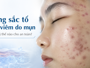 Tăng sắc tố sau viêm do mụn: điều trị thế nào cho an toàn?