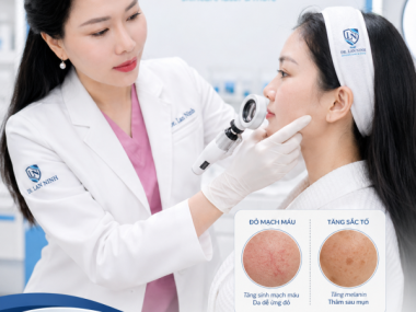 Thâm mụn đỏ hay thâm mụn nâu: điều trị thế nào tại Bình Dương?