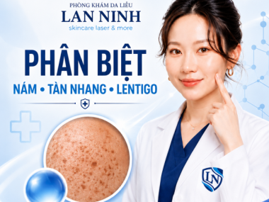 Trị nám Thủ Dầu Một: Phân biệt tàn nhang, lentigo và nám trước laser