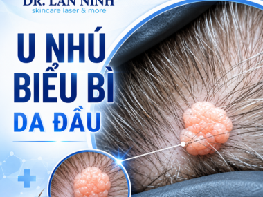 U NHÚ BIỂU BÌ DA ĐẦU: KHI NÀO CẦN CẮT TRỌN VÔ KHUẨN?