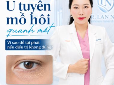 U tuyến mồ hôi quanh mắt ở Thủ Dầu Một: vì sao dễ tái phát?