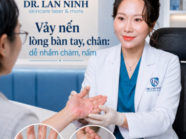 Vảy nến lòng bàn tay, chân: dễ nhầm chàm, nấm