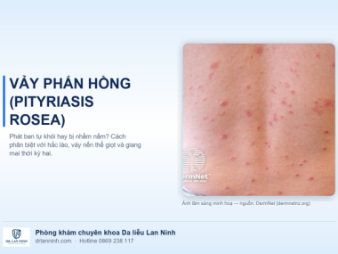 VẢY PHẤN HỒNG (PITYRIASIS ROSEA): PHÁT BAN TỰ KHỎI HAY BỊ NHẦM NẤM