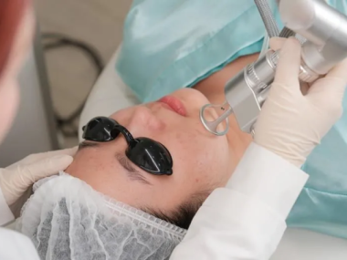 Vì sao laser CO2 fractional không thể “xóa sạch” sẹo rỗ chỉ sau 1 lần điều trị?