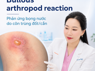 VIÊM DA BỌNG NƯỚC DO CÔN TRÙNG: PHÂN BIỆT VỚI CHỐC VÀ PEMPHIGOID