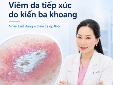 VIÊM DA TIẾP XÚC DO KIẾN BA KHOANG: NHẬN BIẾT VÀ PHÂN BIỆT ZONA
